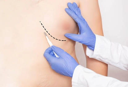 Gynecomastia Surgery Cost in Pune: A Complete Guide